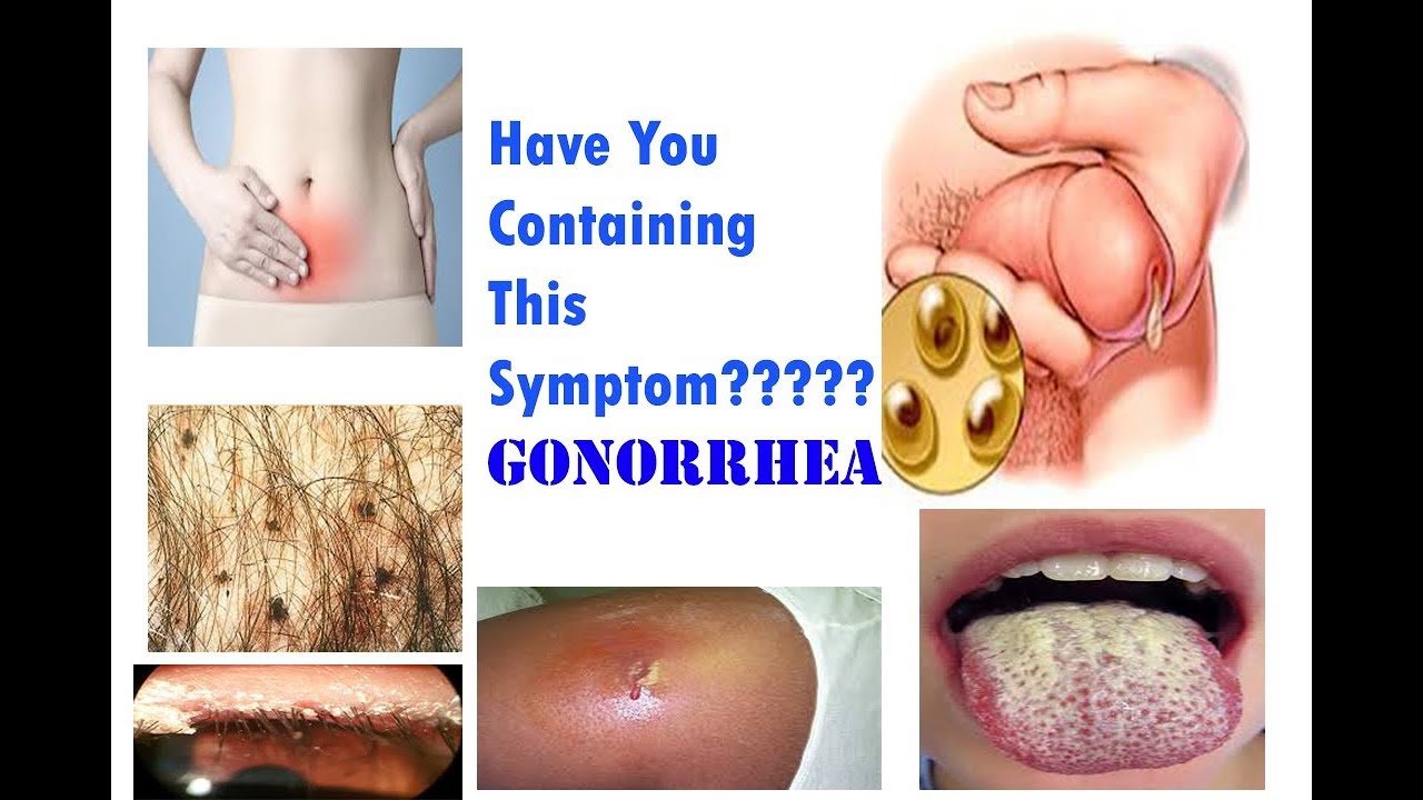 Gonorrhea Symptoms